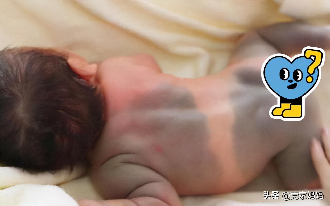 婴儿身上出现青斑图片,新生宝宝很黑的原因