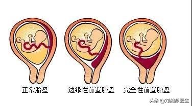 免疫系统造成的孕早期出血怎么办,免疫系统疾病孕期