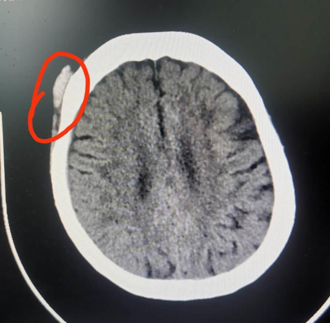 头晕目眩做什么动作缓解,头晕目眩手法复位