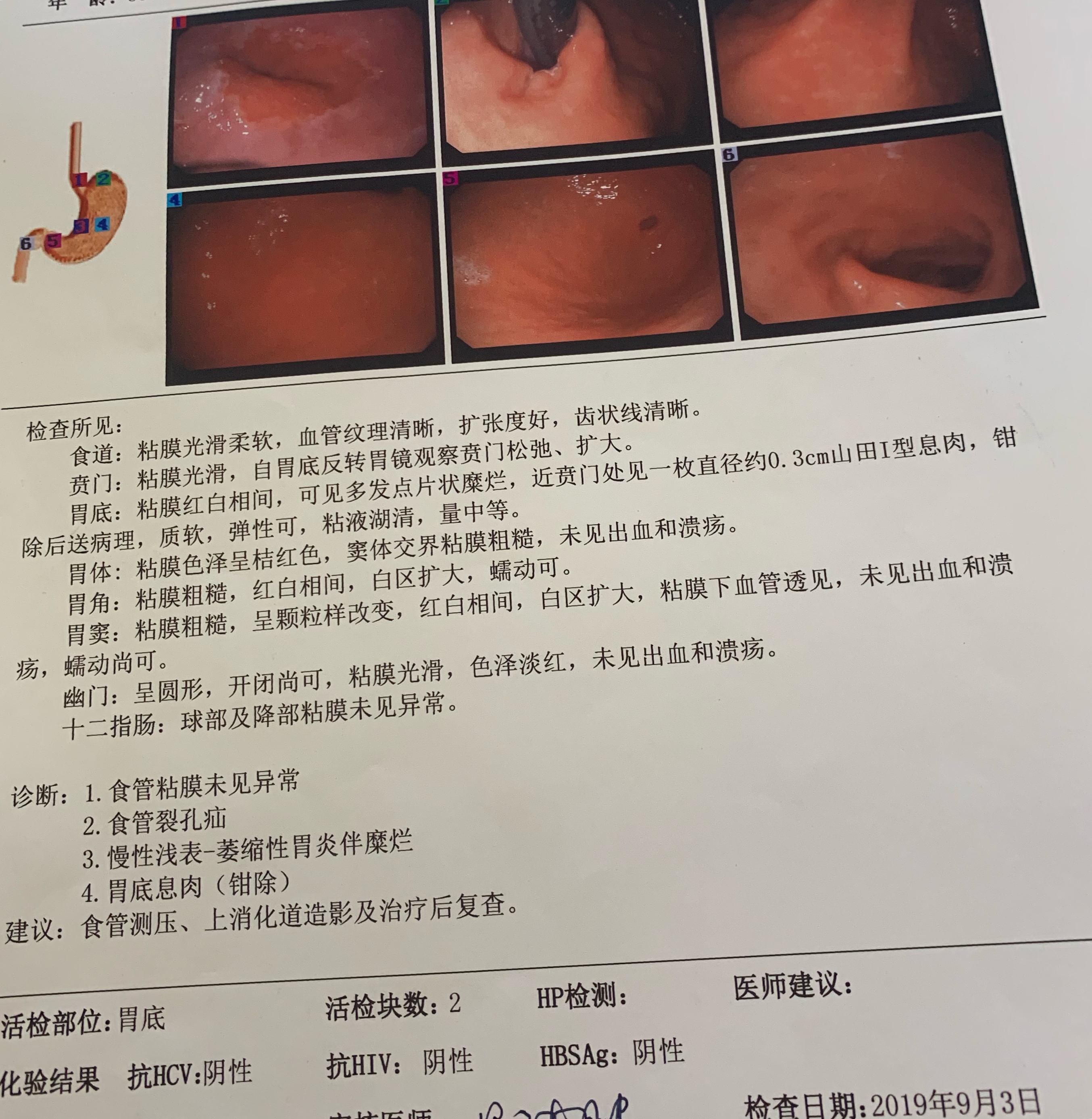 胃食管反流和慢性咳嗽,长期咳嗽是胃食管反流引起的吗