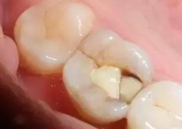 牙齿突然掉了一小块是怎么回事？