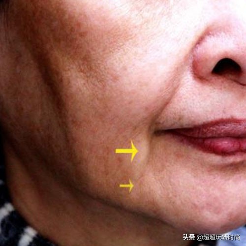 女人人中最近出现了皱纹,女人脸上有明显的皱纹是多少岁了