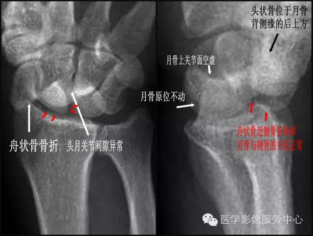 腕骨脱位x线表现,腕骨错位复位手法