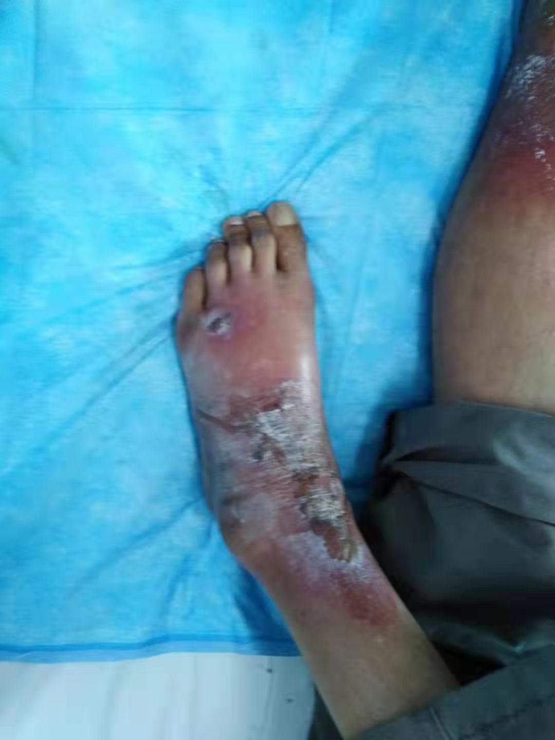 下肢麻木、溃烂要小心，烟酸缺乏是病因