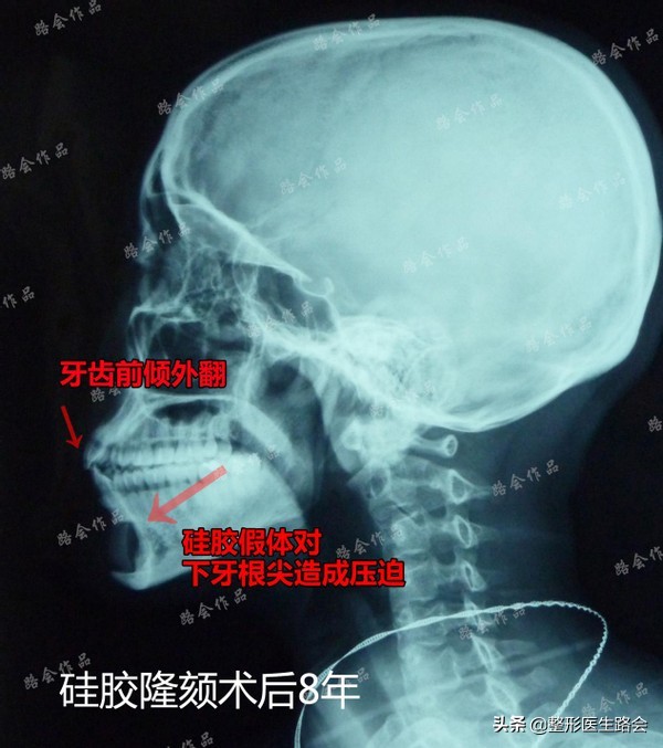 隆下巴硅胶和膨体哪个好,膨体隆下巴和硅胶隆下巴区别