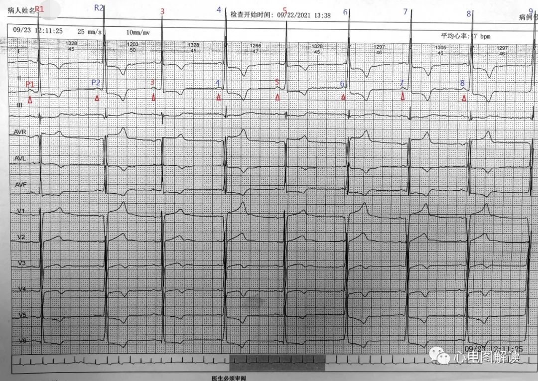 加速室性并行心律,加速的室性逸搏和室性早搏的区别