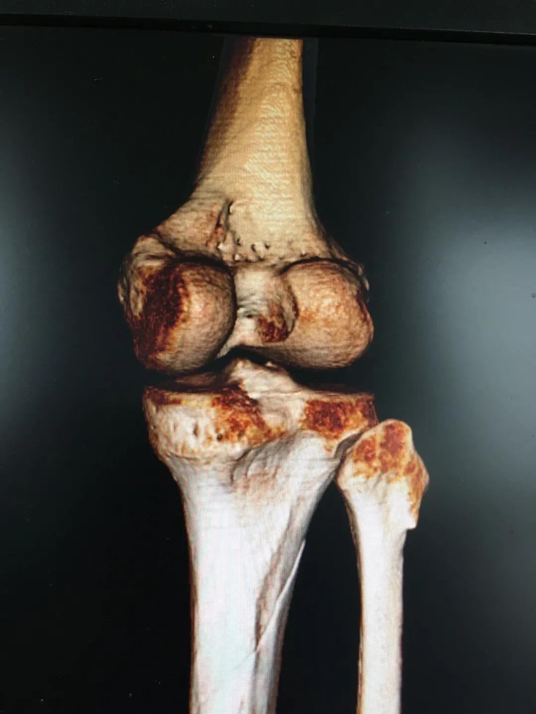 小腿挤压大量淤血能在家自愈吗,小腿碎成三截还能复原吗