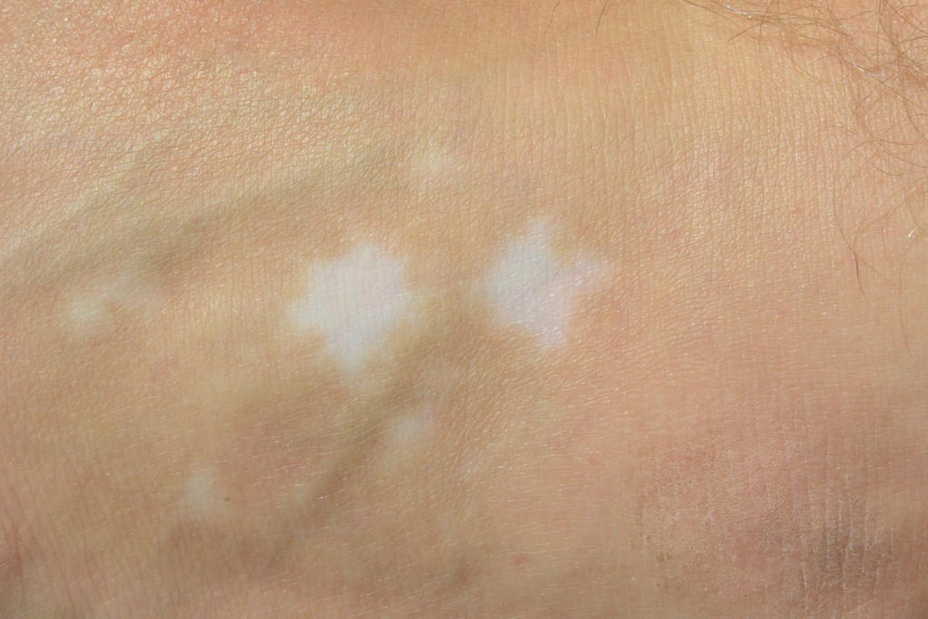 外伤引起白癜风能治愈吗,白癜风多久能治好