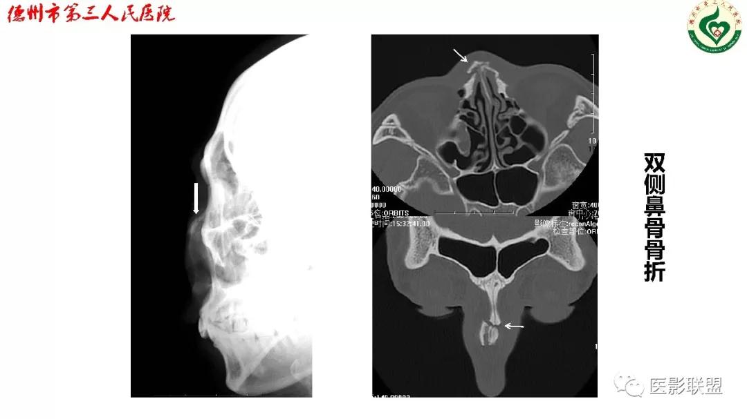 鼻骨骨折dr影像表现,鼻骨骨折影像学诊断