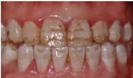 涂氟后牙齿上固体会吃下去么,涂氟涂到牙龈有损害吗