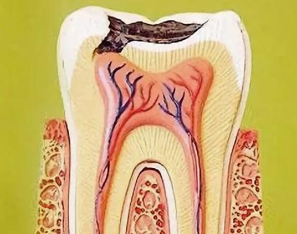当智齿和蛀牙一块犯的时候,智齿牙髓炎直接拔还是开髓引流