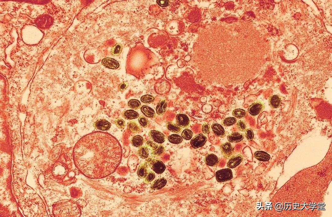 曾造成数亿人死亡的“天花”，为什么能被彻底消灭掉