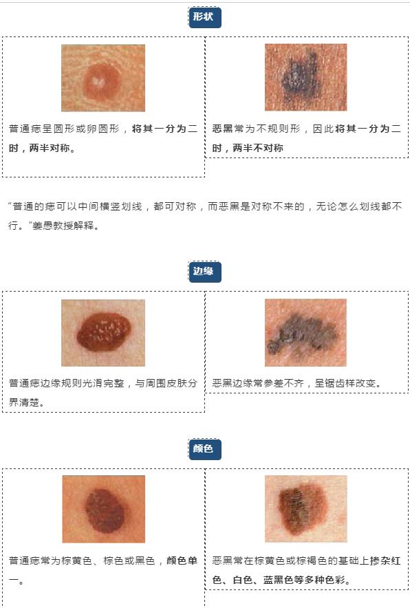 医生提醒这3种痣可能与癌症有关,长在哪些地方的痣都要切