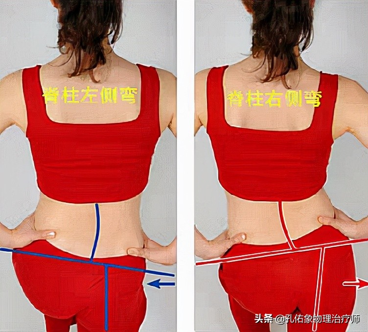 腰疼脊柱侧弯是什么样,腰痛引起的脊柱侧弯原因
