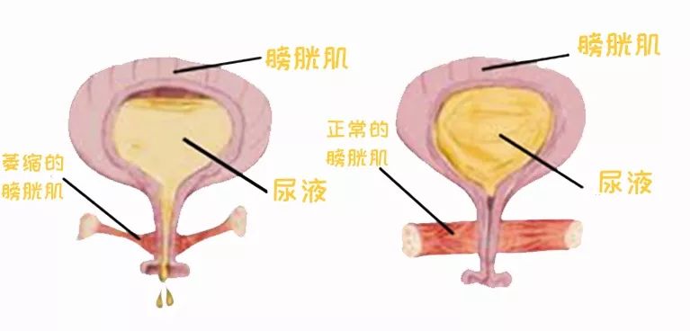 笑会笑出尿来是不是病,笑是好事还是坏事