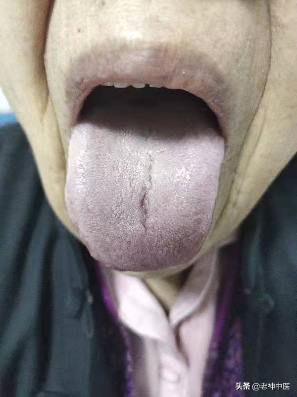 老人支气管肺炎咳嗽特效药,老人肺炎咳嗽痰多有什么特效药