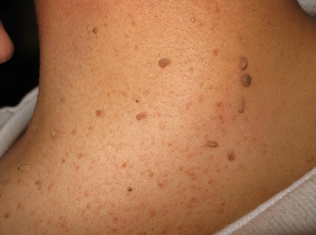 脖子和腋下有小肉粒用什么药涂,脖子和腋下的小肉粒是什么