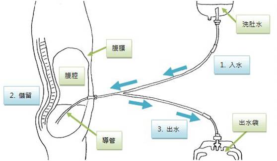 尿毒症患者该如何选择腹膜透析或血液透析