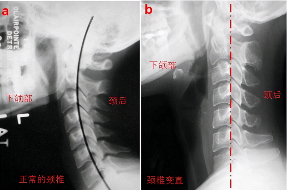 颈部不适的缓解训练,如何缓解颈部肩部疼痛