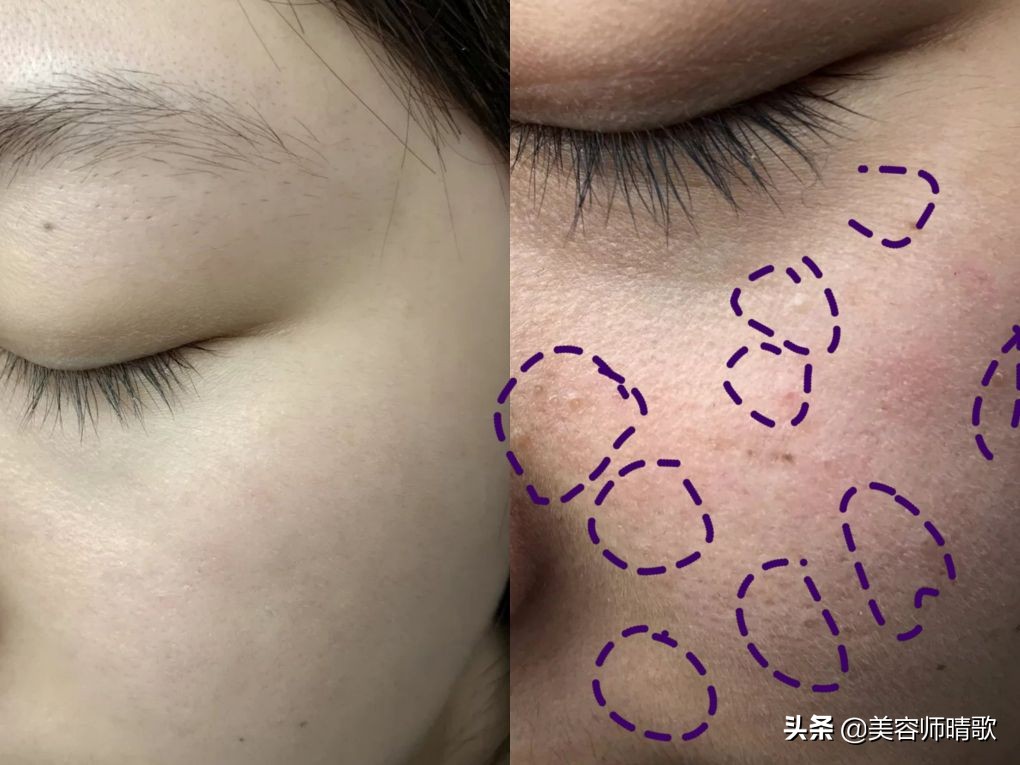 长斑应该关注的饮食事项,长斑的过程你了解了吗