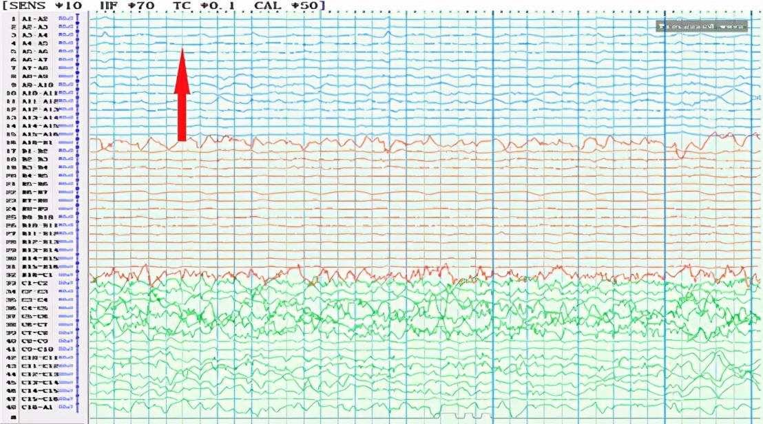 良性癫痫会痴笑发作吗,痴笑性癫痫是什么