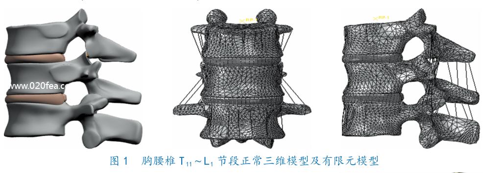 腰1椎体压缩骨折复发要卧床几天,胸12腰4椎体压缩骨折几级工伤