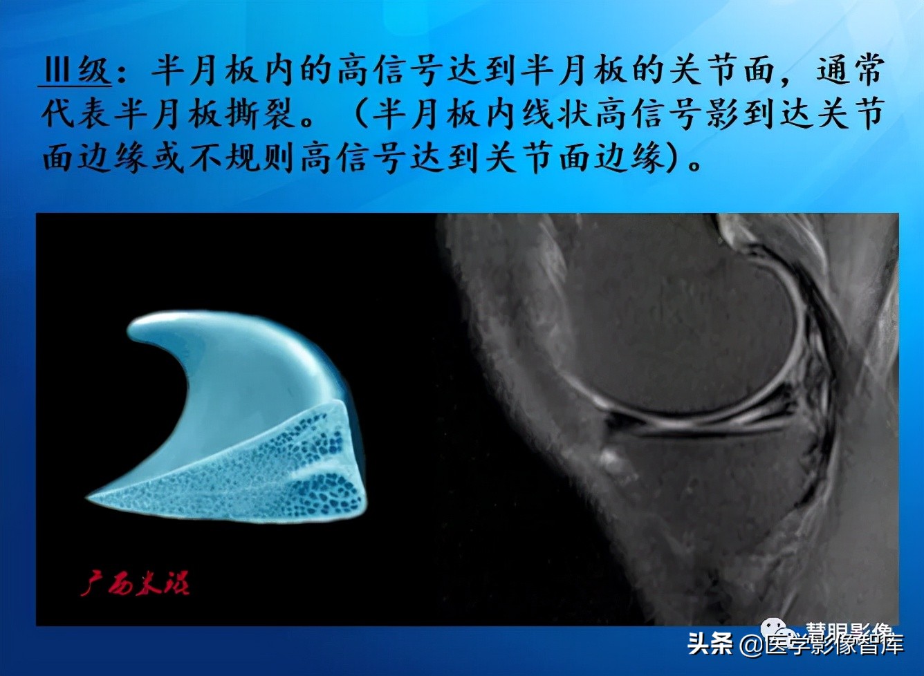 膝关节半月板损伤的解剖结构图,半月板mri解剖图解