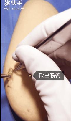 香蕉割包皮，洋葱剖腹产？这是我见过最秀的医生