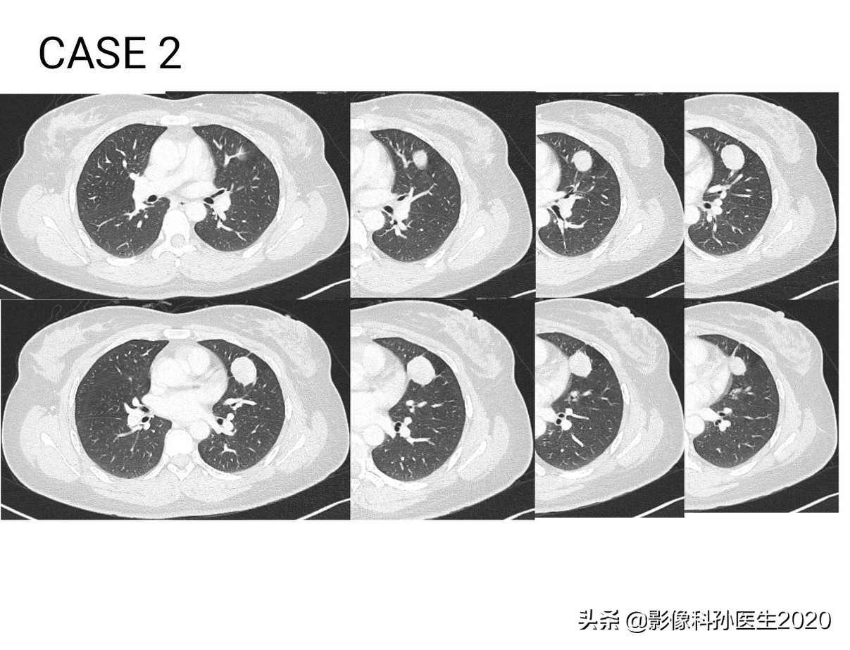 肌纤维母细胞瘤扩切能切干净吗,肌纤维母细胞瘤最好的治疗方法