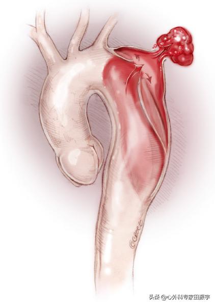 主动脉夹层破裂b型,急性主动脉夹层动脉瘤破裂