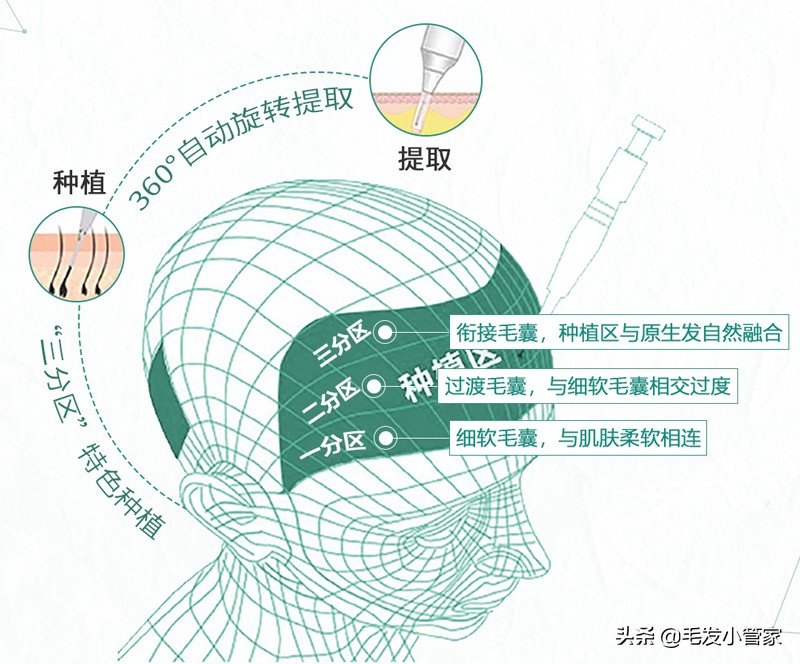 植发一般从哪里取发,植发打麻药对智商有影响吗
