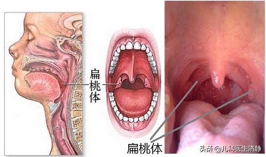 扁桃体化脓高烧反复不退怎么办,扁桃体化脓高热不退怎么处理
