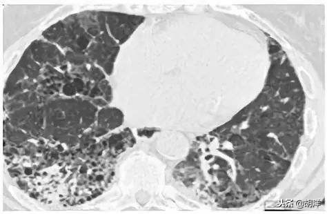 不输肺癌？得了间质性肺病真的只能活两三年吗？专家讲出大实话！