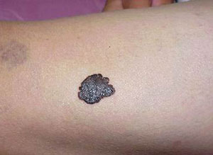 脸上的痦子越长越大怎么办,脸上的痣什么样的容易癌变