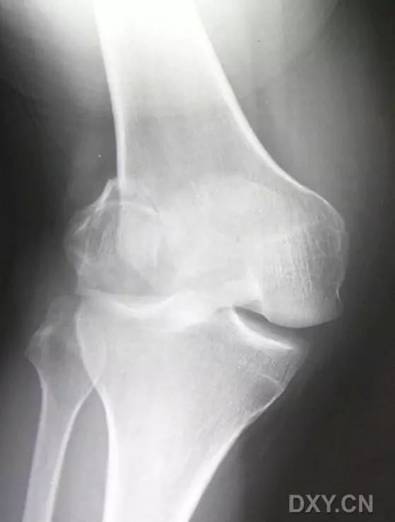 所有骨折都叫什么名字,骨折的名称有哪些