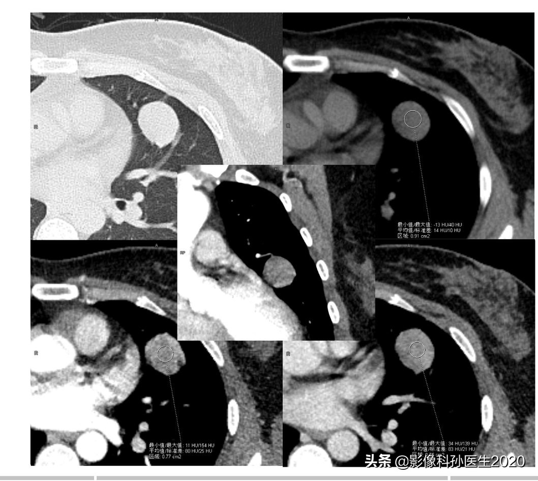 肌纤维母细胞瘤扩切能切干净吗,肌纤维母细胞瘤最好的治疗方法