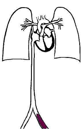 喘不上气是因为揉腿？为啥要警惕两腿围相差1cm？