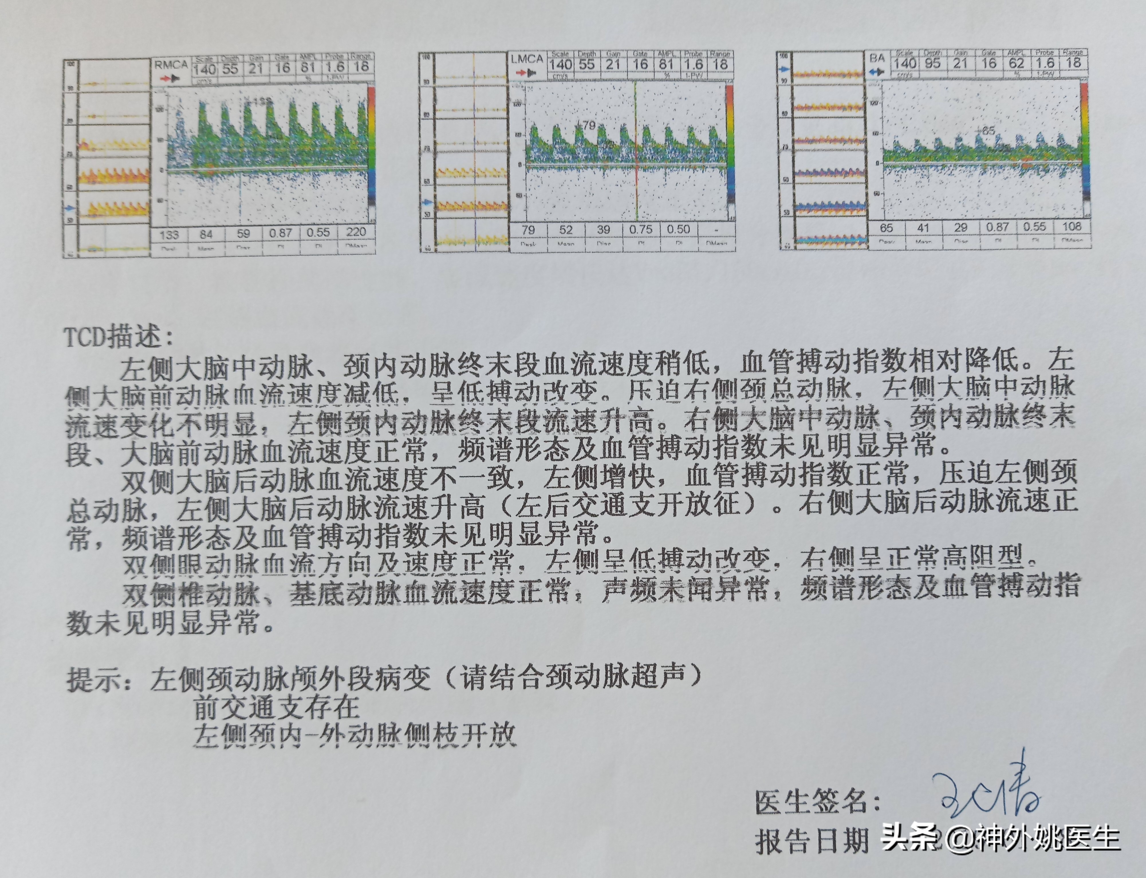 颈内动脉狭窄内膜剥脱术风险大吗,颈动脉内膜摘除手术