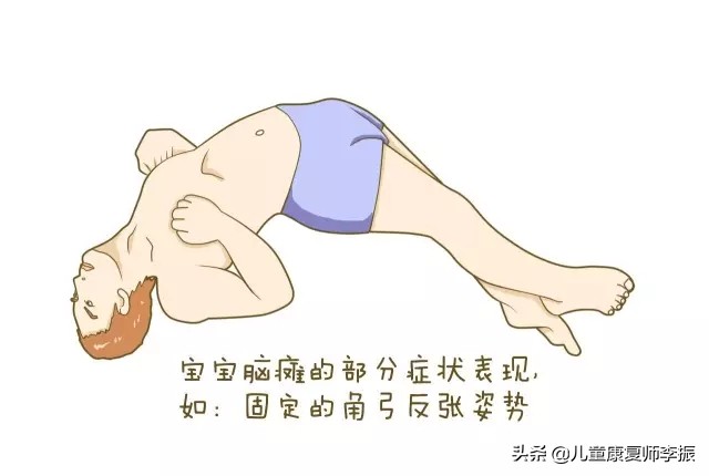 脑瘫儿侧卧睡觉姿势,宝宝侧卧头一直后仰