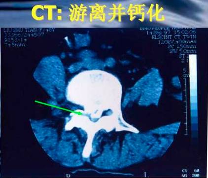 腰椎间盘突出症的临床诊治策略,腰椎间盘突出症的临床诊治