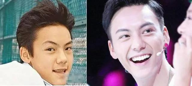 明星整牙前后对比,龅牙明星整牙前后的惊人变化