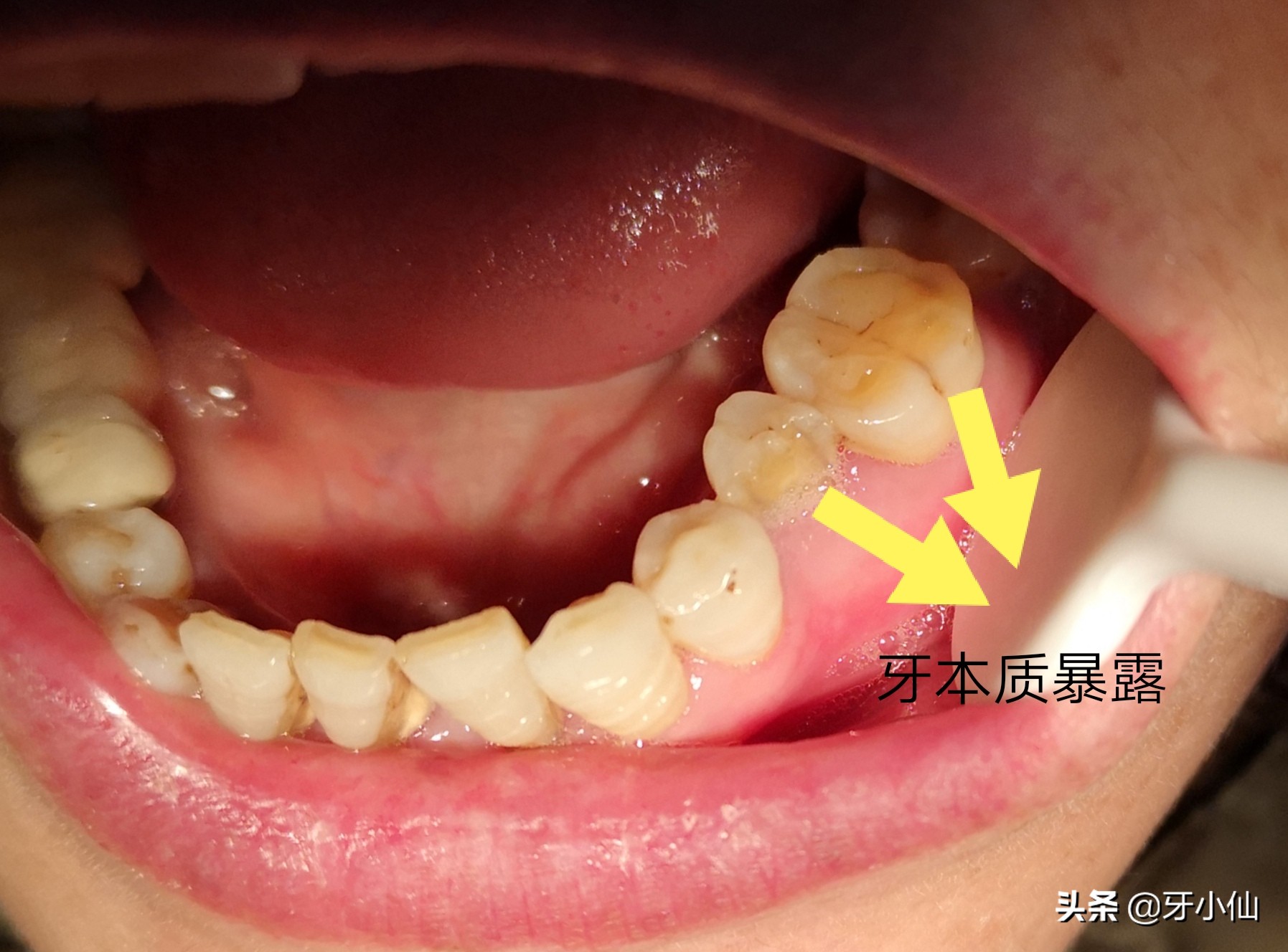 牙太痛，吃不了热辣火锅、冰爽雪糕、酸甜水果，怎么能当吃货？