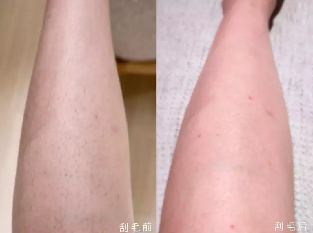 史上最实用脱毛术！夏天再也不为这事发愁啦
