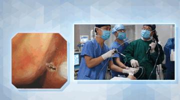 高位气管淀粉样变的处理|王洪武