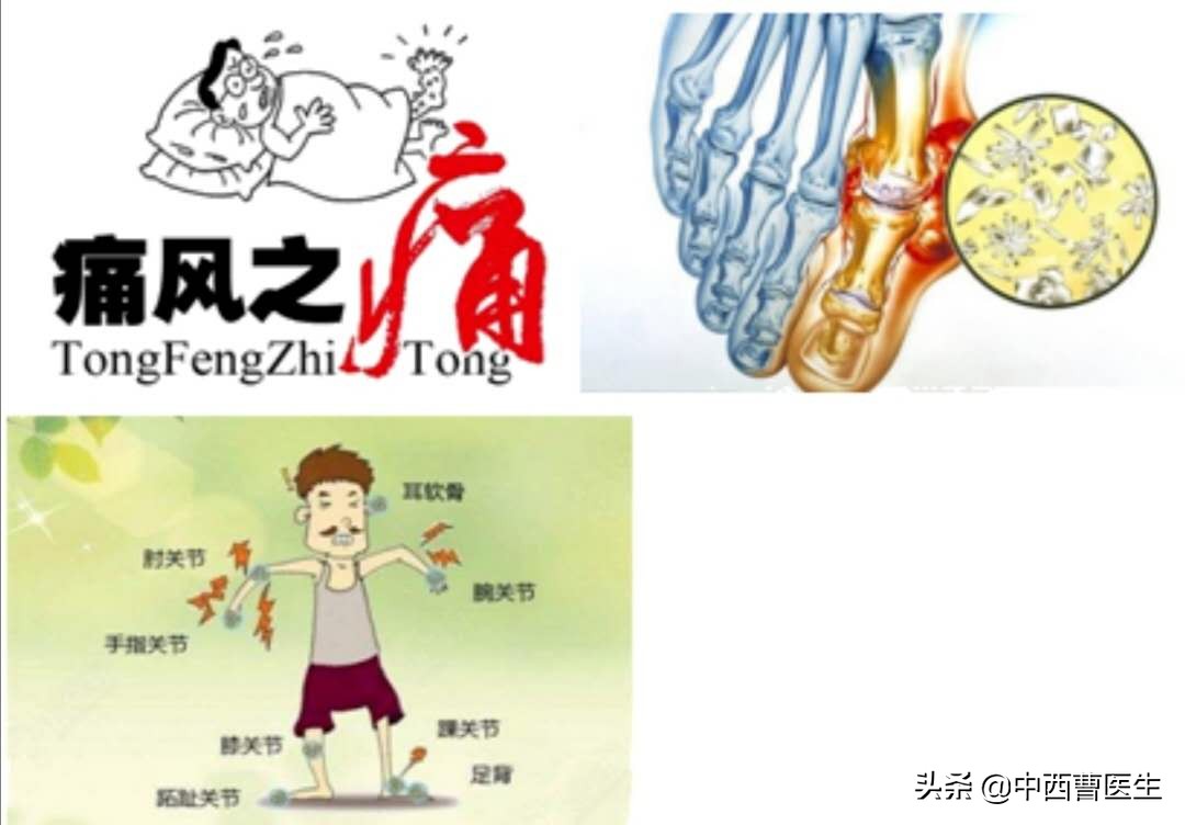 痛风的临床表现及健康教育ppt,痛风的诊断与治疗的内容