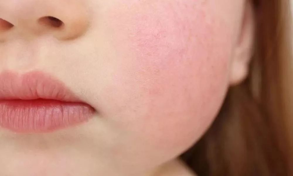 「健康」孩子感冒、嗓子疼要消炎吗？小心用错消炎药害了娃