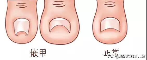 孩子脚趾甲红肿,孩子脚趾头有甲沟炎怎么处理