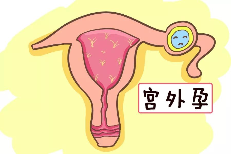 如何提防宫外孕,怎样识别宫外孕和怀孕