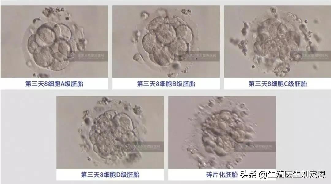 什么情况下可以移植三个胚胎,三级胚胎移植成功案例