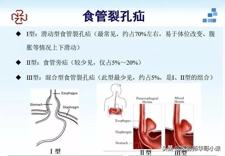 「精品课件」胸部膈肌的解剖及常见病变影像的表现